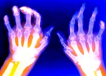 Tratamiento de la artritis